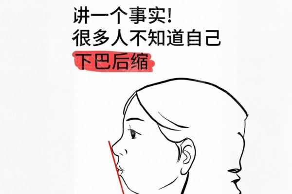 硅胶vs膨体下巴对比 硅胶vs膨体下巴对比