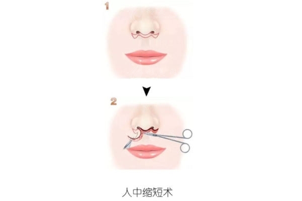 人中缩短术长期效果跟踪对比 人中缩短术长期效果跟踪对比