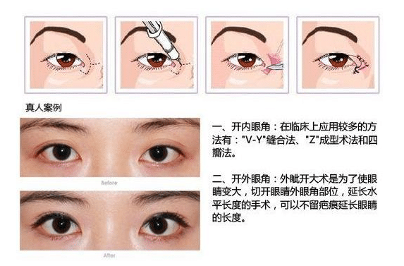 开眼角