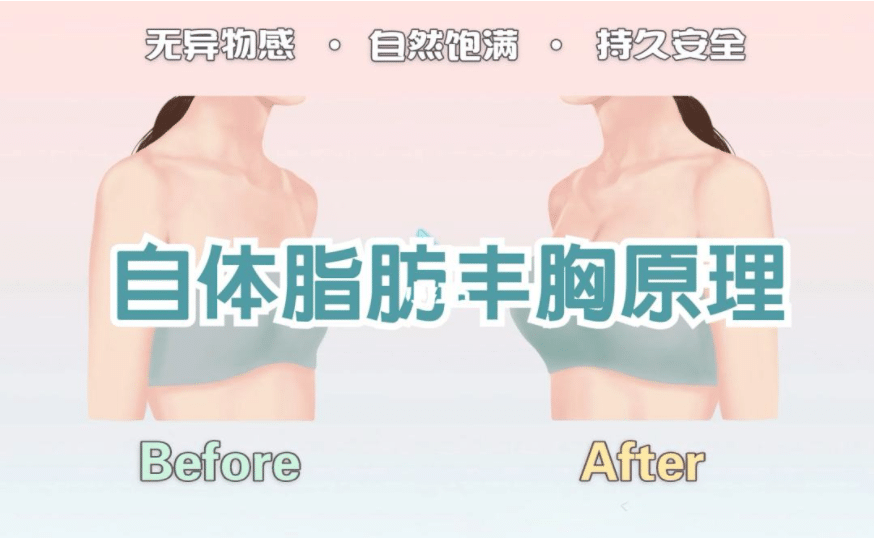 自体脂肪丰胸术多少钱？自体脂肪丰胸要多少次才行？