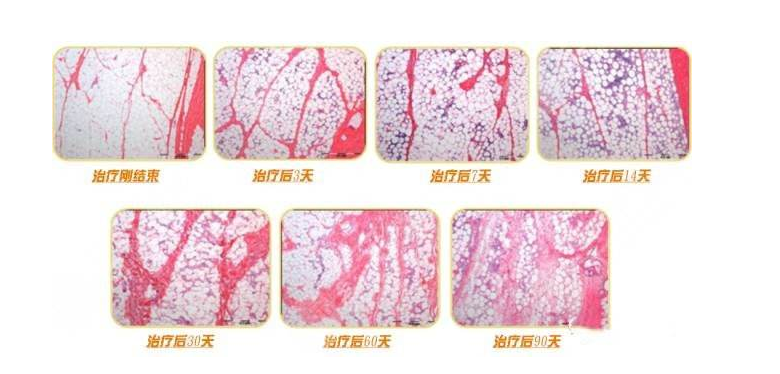 超脂塑是什么？与传统吸脂有什么优势？