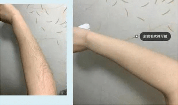 超冰脱毛和冰点脱毛有什么区别?
