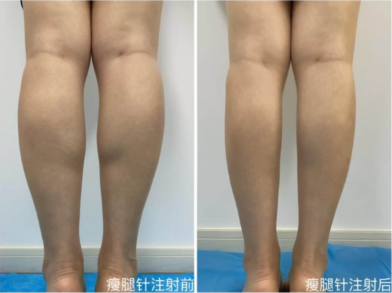 注射瘦腿针有副作用吗，会反弹吗?