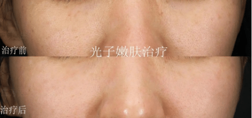 光子嫩肤有依赖性吗?光子嫩肤恢复期?