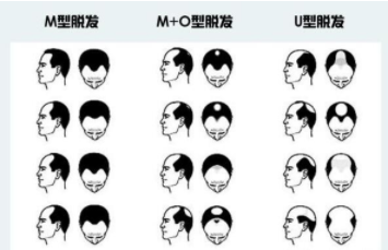 植发1000单位图片！植发的原理及影响手术后效果的因素介绍