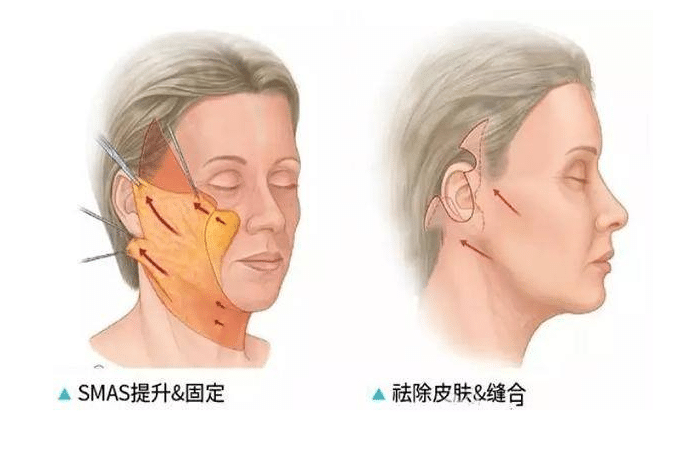 小拉皮手术