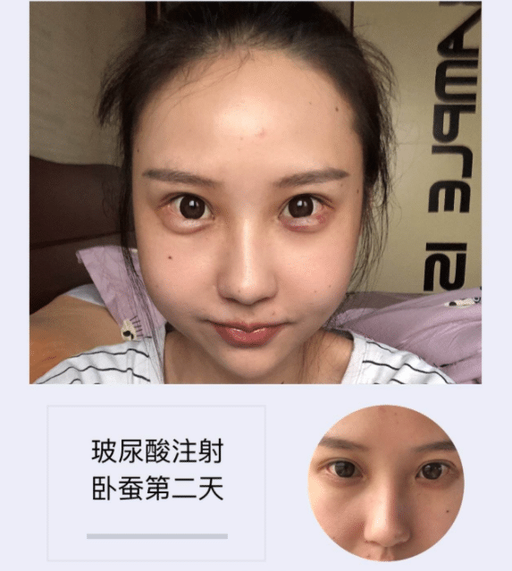 玻尿酸注射卧蚕有多长的恢复期?