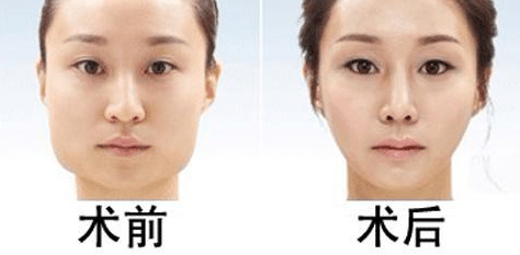 磨骨手术的效果及后遗症