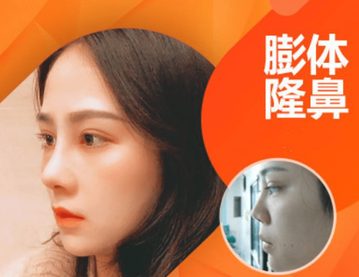 膨体隆鼻效果怎么样？