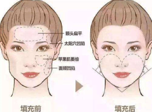 面部凹陷填充脂肪过多怎么办？如何修复？
