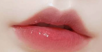 丰唇的效果如何？术后如何护理？