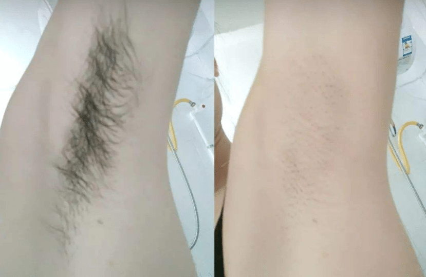 永久性脱毛前后对比