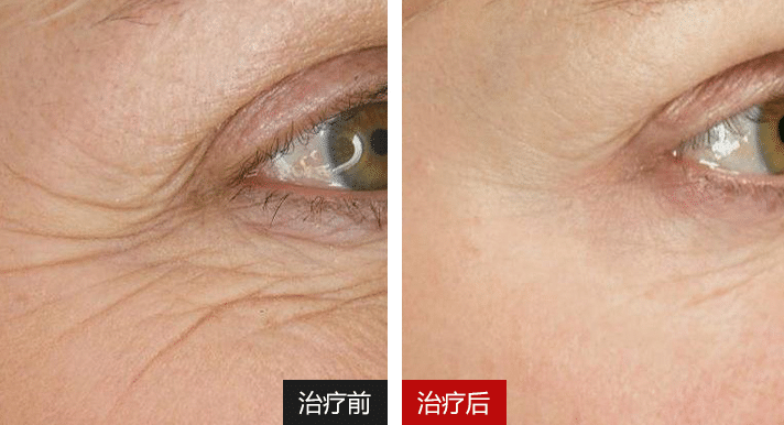 眼周抗衰前后对比