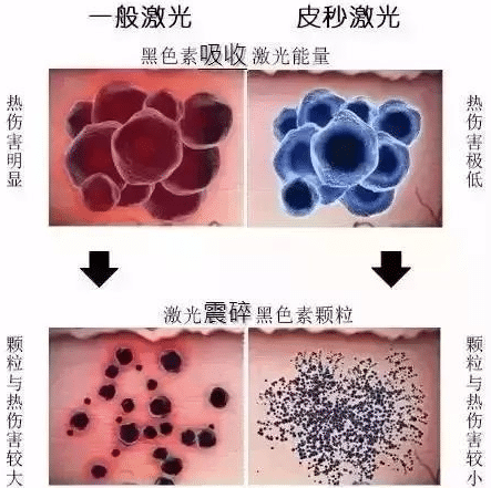 黄褐斑可以祛除吗？怎么才能彻底祛除？