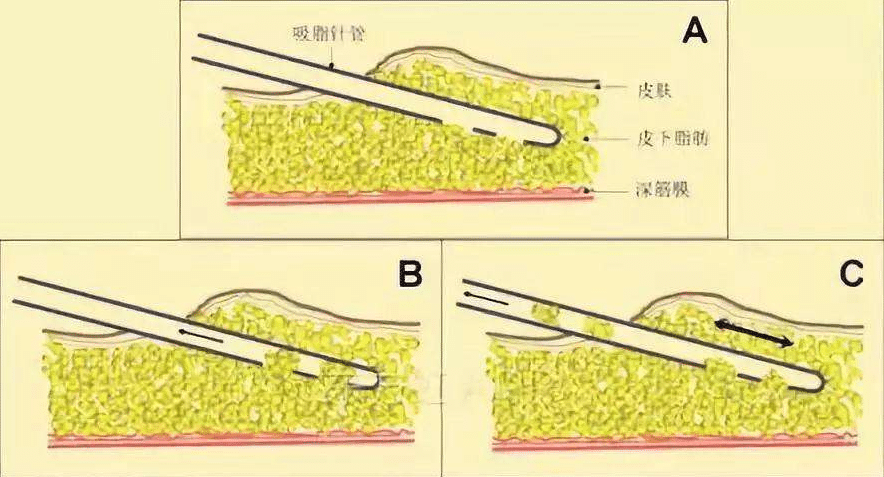 大腿抽脂对身体有害吗？会反弹吗？