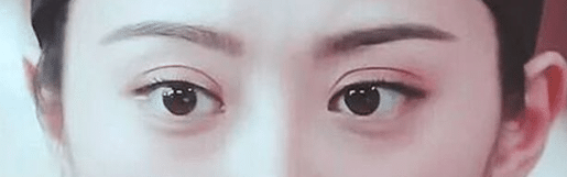 双眼皮