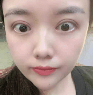 双眼皮