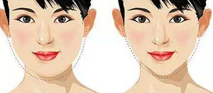 脂肪型双下巴