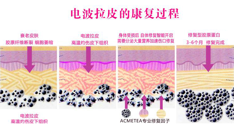电波拉皮效果好吗？术后会有副作用吗？