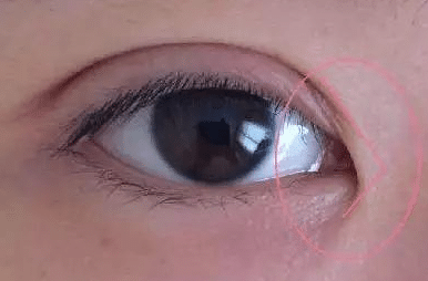 开眼角恢复