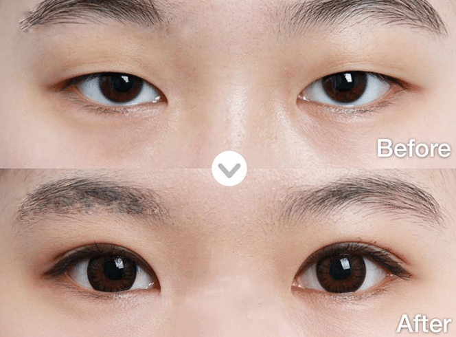 单眼皮适合开眼角吗?会不会好看?_形美网