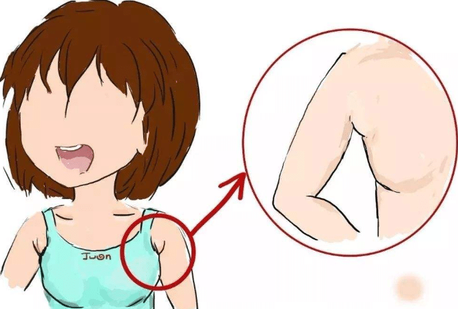 吸脂去副乳前后对比