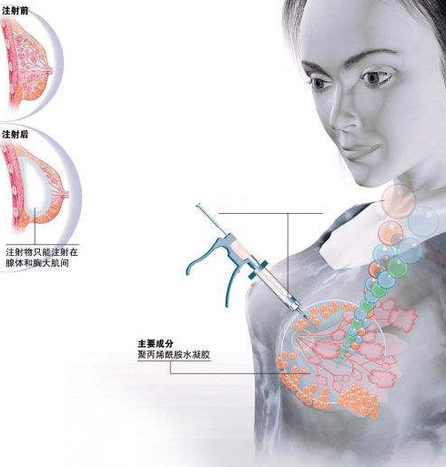 液态丰胸是什么？
