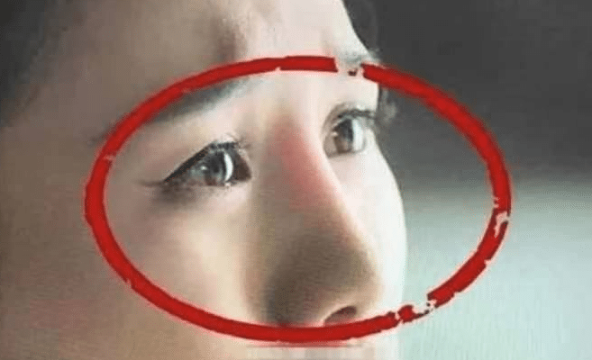 隆鼻假体透光