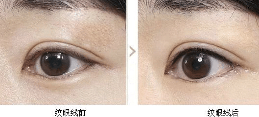 纹眼线前后对比
