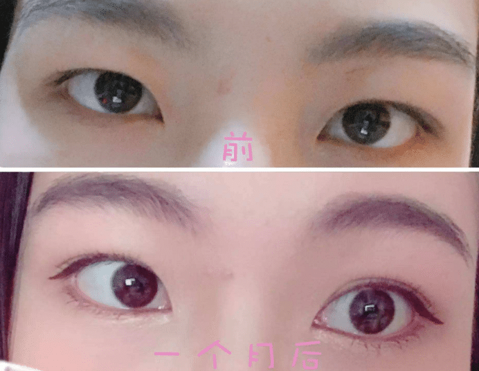 眼皮吸脂前后对比