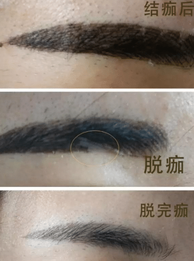 纹眉后结痂脱落