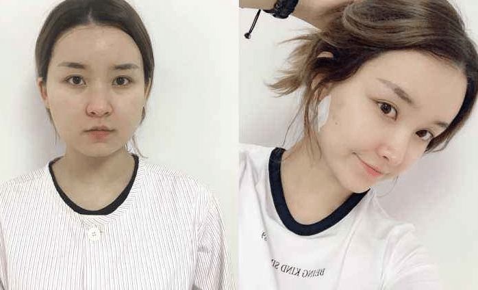 面部吸脂前后对比