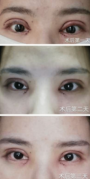 眼综合术后护理