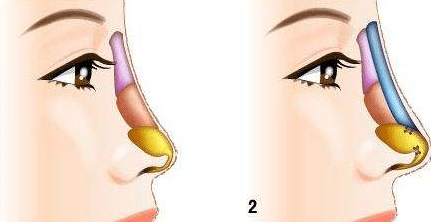 膨体隆鼻的感染率高吗？