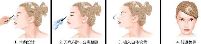 耳软骨隆鼻多久可以恢复呢？取出耳软骨会有后遗症吗？