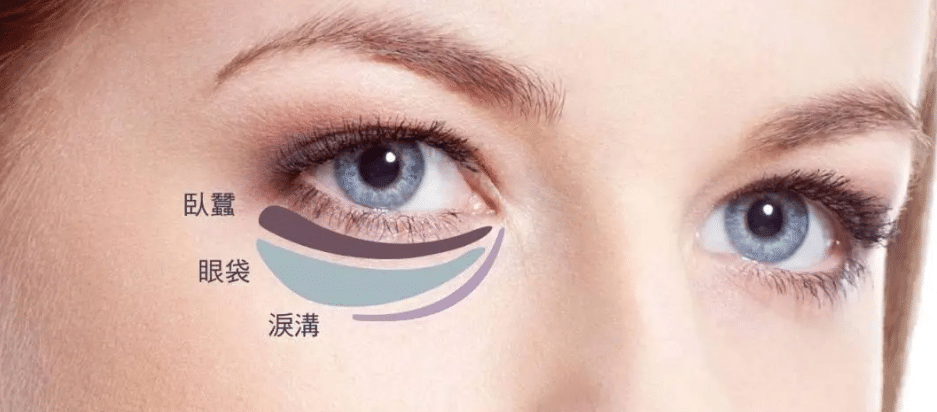 早起眼袋肿怎么办？去眼袋用热水敷还是冷水敷效果好？