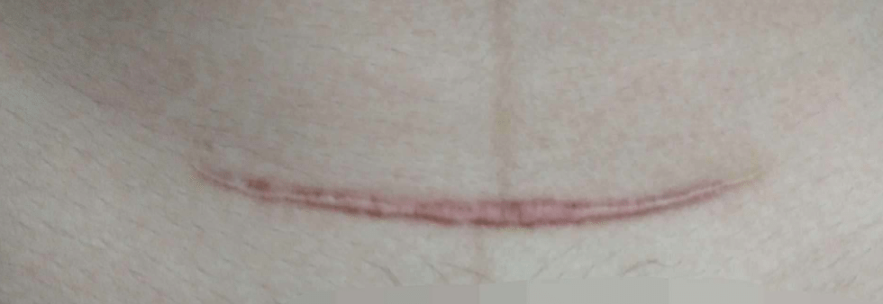 剖腹产疤痕