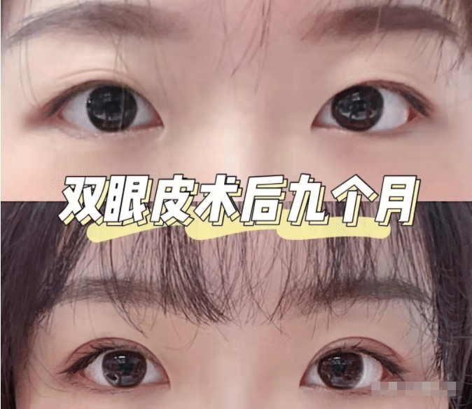 双眼皮哪个好?哪种双眼皮手术方法适合我?