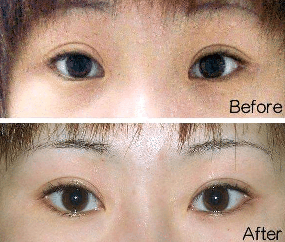 开眼角前后对比