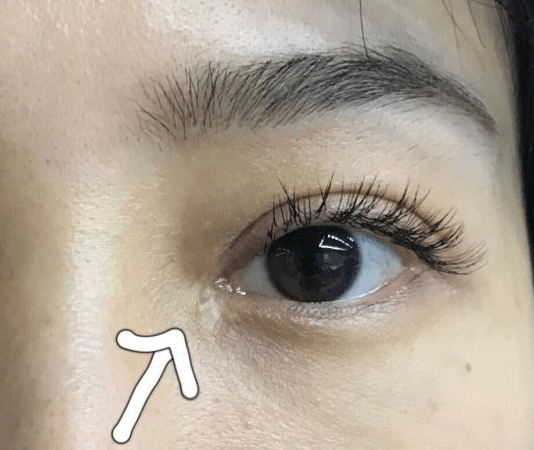 开眼角后的疤痕增生