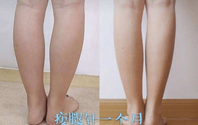 瘦腿针前后对比
