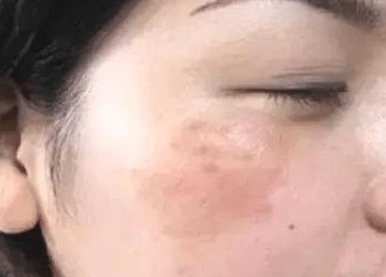 妊娠斑