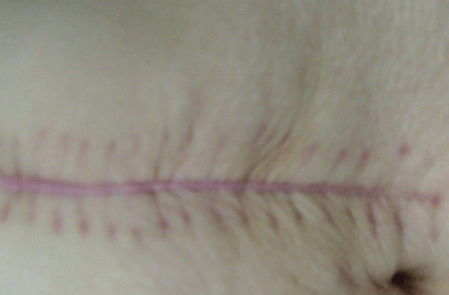 剖腹产瘢痕
