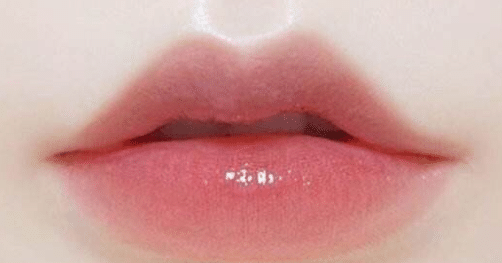 做M唇整形手术方法有哪些？选择手术好还是注射好？