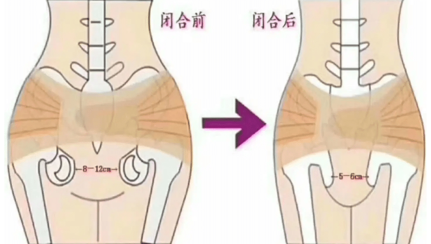 盆骨修复前后对比