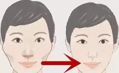 磨颧骨前后对比