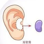耳软骨