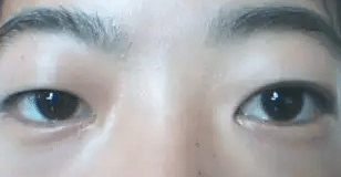 不适合做双眼皮的几种眼睛类型！金鱼眼|圆眼睛|脂肪眼