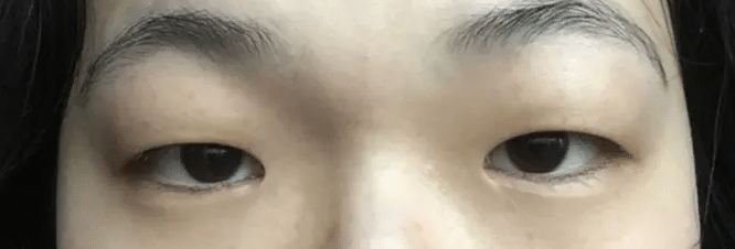 脂肪肿型眼睛