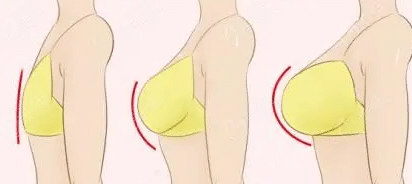 太瘦的人不能做自体脂肪隆胸吗？为什么？